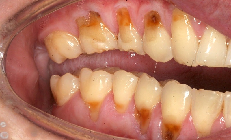 Зубы при булимии