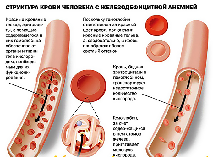 Сывороточное железо повышено. Причины у ребенка, подростка, взрослых, беременных. Лечение