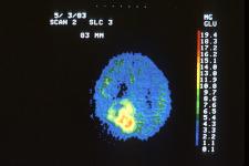 PET image of a brain tumor